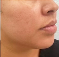 After Microneedling Treatment at South Bay Med Spa: Significant reduction in acne scars and improved skin texture on a Latina patient.