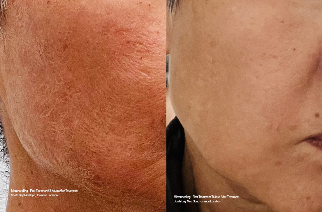 Microneedling with PRP and PDRN: What to Expect 