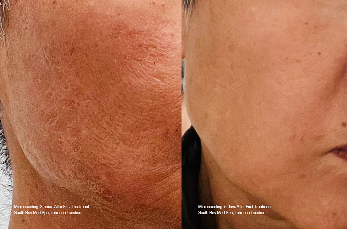 Microneedling-First-Treatment-Southbaymedspa-Post-Treatment-SidebySide.png