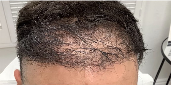 Does PRP Actually Work for Hair Loss? Here's What the Research Says