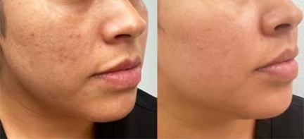 Micro-infusion vs Microneedling