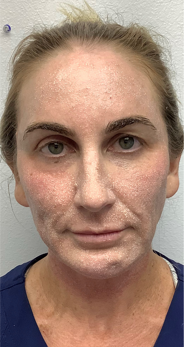 Alma Hybrid CO2 laser treatment results for facial rejuvenation at South Bay Med Spa. This image shows skin immediately post-treatment. 