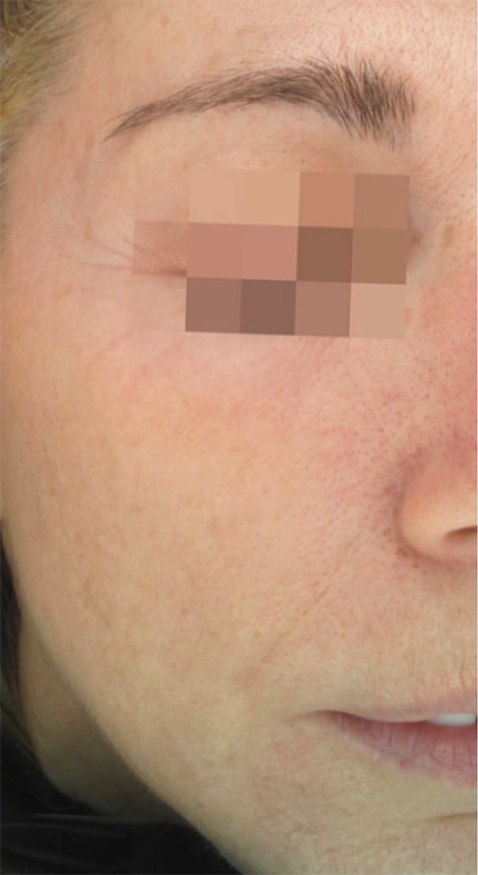 After VI Peel. Significant reduction in melasma for a clearer, more even complexion.