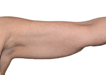Before Coolsculpting Upper Arm