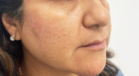 After Morpheus8 treatment.  A visibly tighter, more defined jawline.