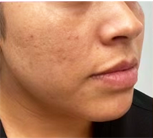 Before Microneedling Treatment at South Bay Med Spa: Visible acne scarring on the cheek of a female Latina patient in her 30s.