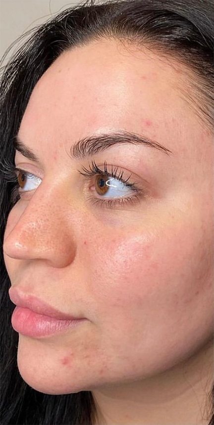 Before VI Peel Treatment