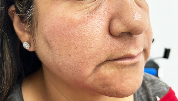 Before Morpheus8 Treatment