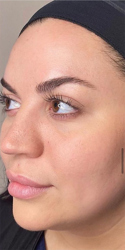 After VI Peel. Visibly rejuvenated skin — with reduced acne, scarring, hyperpigmentation, fine lines, and sun damage.