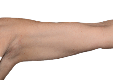After Coolsculpting Upper Arm - 6 Weeks After 2 Treatment Visits.  (Results may vary from patient to patient.)