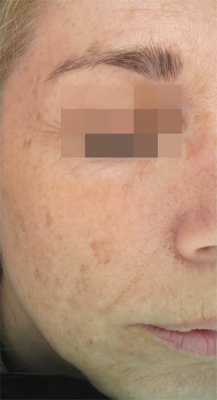 Before VI Peel Treatment
