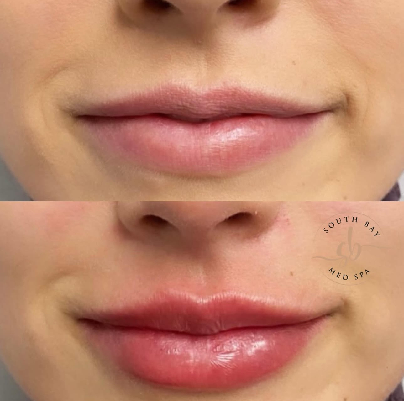 Before & After Lip Filler 