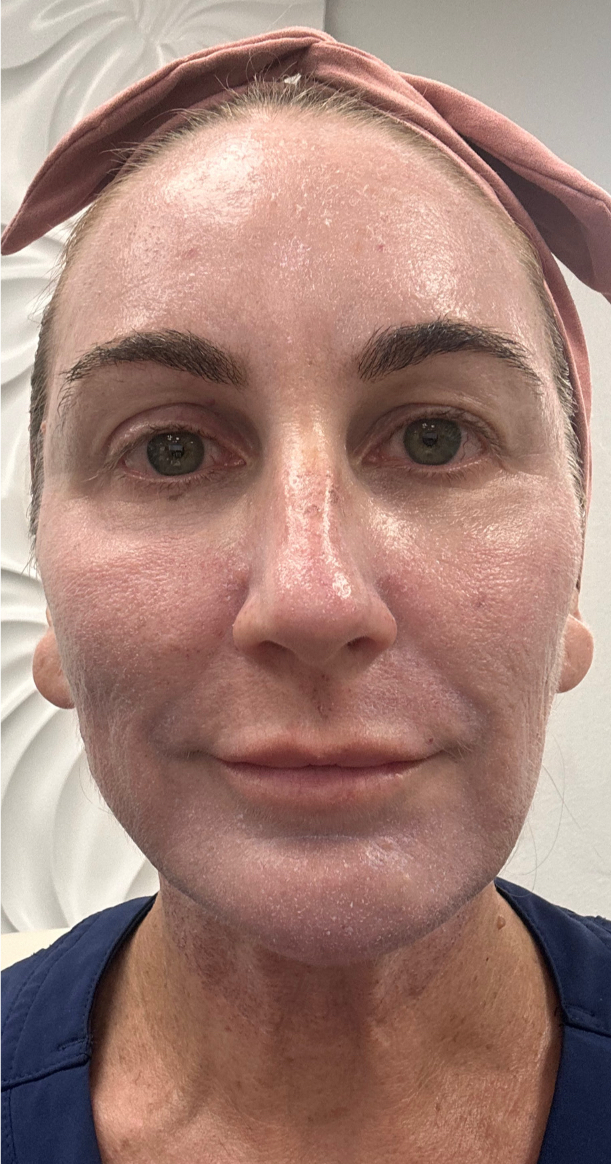 Alma Hybrid CO2 laser treatment results for facial rejuvenation at South Bay Med Spa. This image shows significant skin tightening and texture improvement at 3 months.