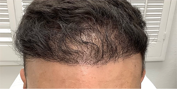 After PRP (Platelet-Rich Plasma) hair therapy — nicknamed "Liquid Gold" for a reason. This nutrient-rich treatment harnesses your body's own growth factors to stimulate healing and promote fuller, healthier hair.