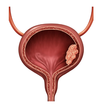 Illustration of a bladder with a tumor on the inner wall.