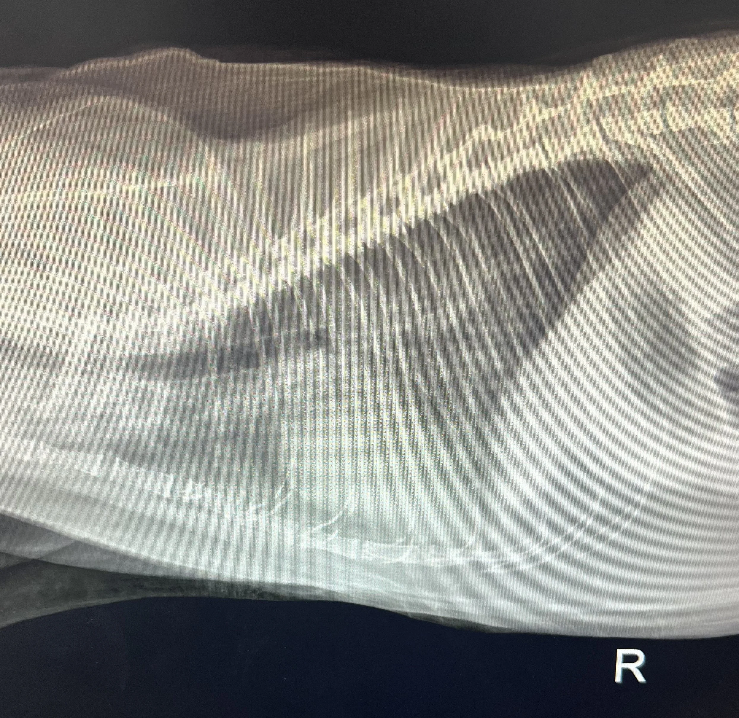 Chest X-ray showing the lungs and heart, with the right side marked 'R'.