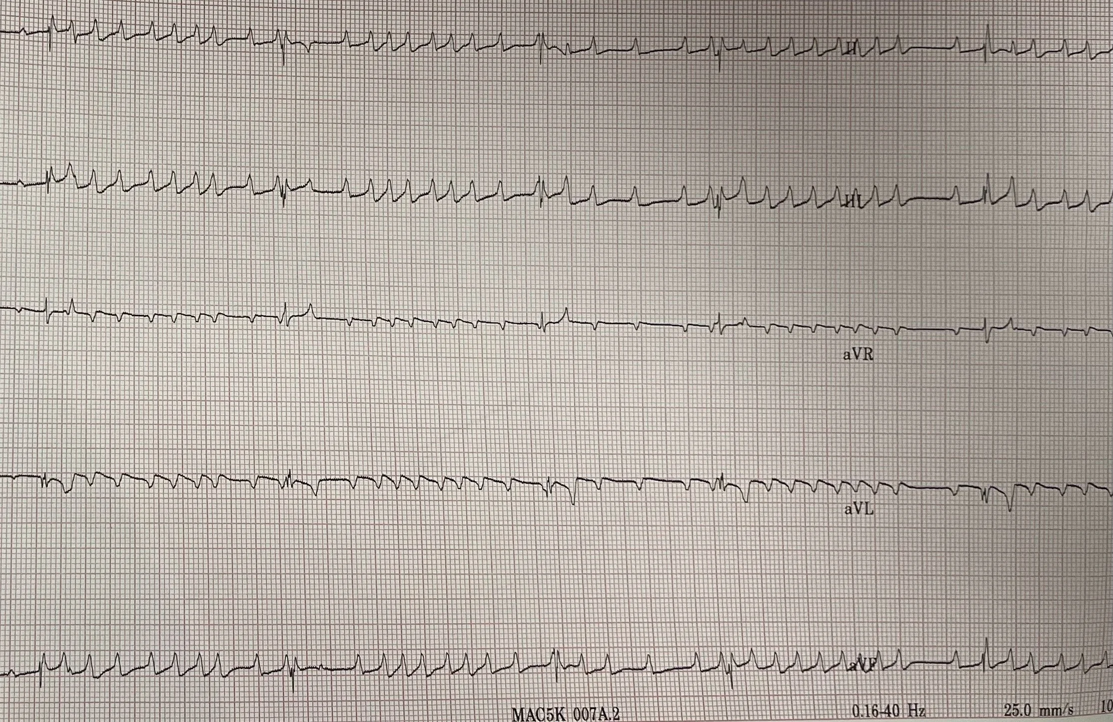 Electrocardiogram (ECG) printout showing multiple leads with cardiac electrical activity.