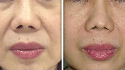 Side-by-side comparison of a woman's face, focusing on her nose and lips, showing before and after skin treatment results.