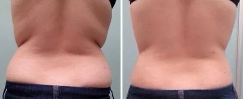 Side-by-side comparison of a person's back showing reduction in fat and improved contour after weight loss or treatment.