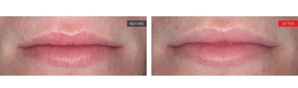 Comparison of lips before and after a cosmetic treatment, showing smoother lips after treatment.