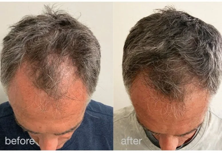 Comparison photo of a man's hair before and after hair restoration, showing increased hair density and coverage in the after image.