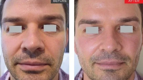 Side-by-side comparison of a man's face before and after skincare treatment, showing improved skin texture and appearance in the after photo.