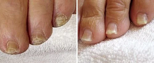Close-up of dirty and toenails with dirt and discoloration on a person's toes.