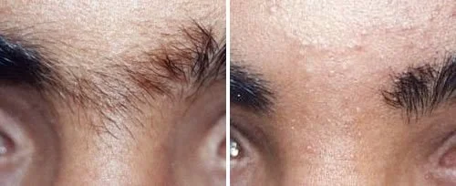 Close-up of a person's forehead before and after skincare treatment showing improved skin texture and clarity in the after image.