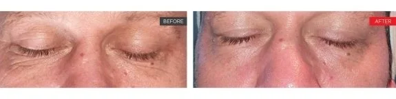 Comparison of eyelids before and after a cosmetic procedure, showing reduced sagging in the after image.