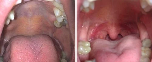 Close-up view of the inside of a mouth, showing the tongue and upper and lower teeth.