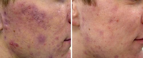 Side-by-side comparison of a person's face showing acne before and after treatment, with visible reduction in blemishes.