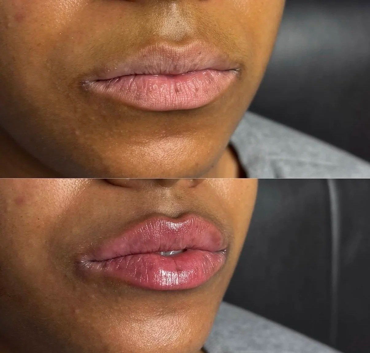 Natural lip filler results at Novirra in Columbus, Ohio. Located in the Short North. 