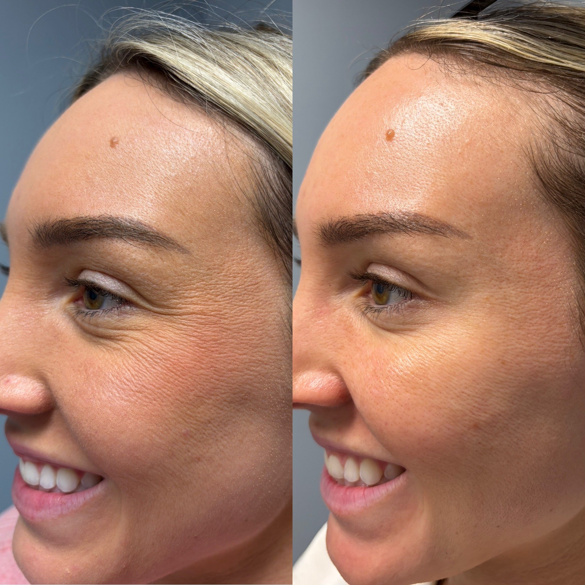 Wrinkle relaxer (Xeomin) before and after at Novirra in Columbus, Ohio. Located in the Short North.