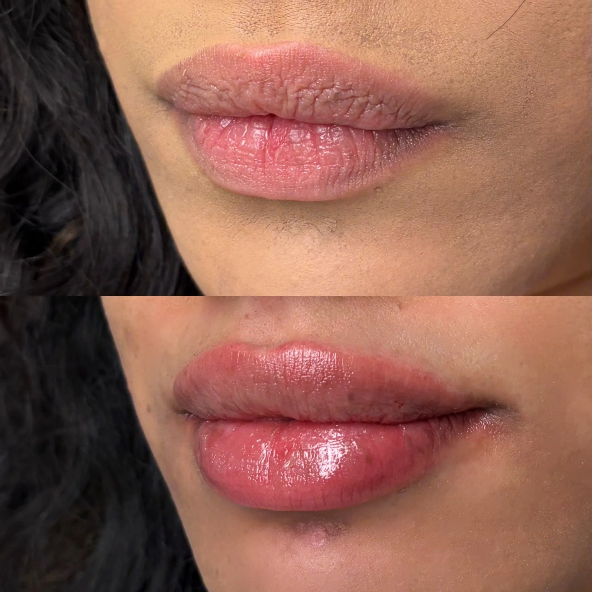 Natural lip filler results at Novirra in Columbus, Ohio. Located in the Short North.