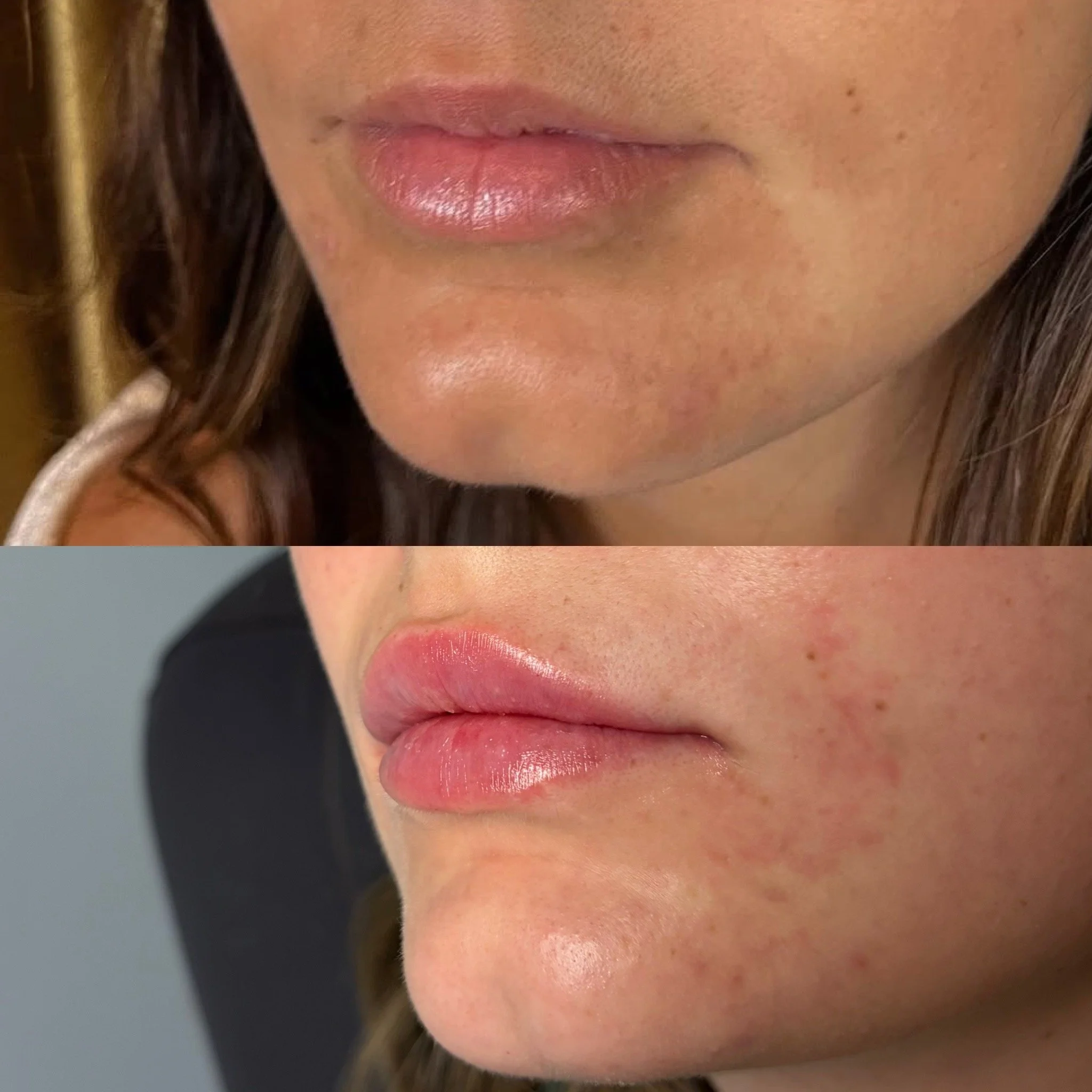 Natural lip filler results at Novirra in Columbus, Ohio. Located in the Short North. 