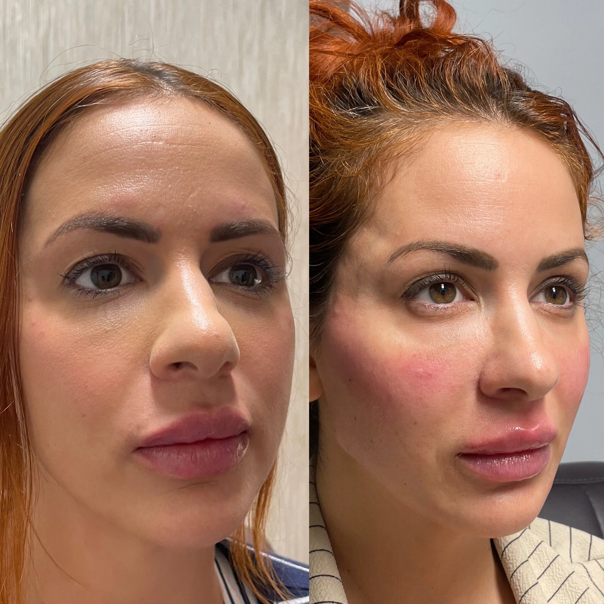 Facial balancing dermal filler before and after at Novirra in Columbus, Ohio. Located in the Short North.