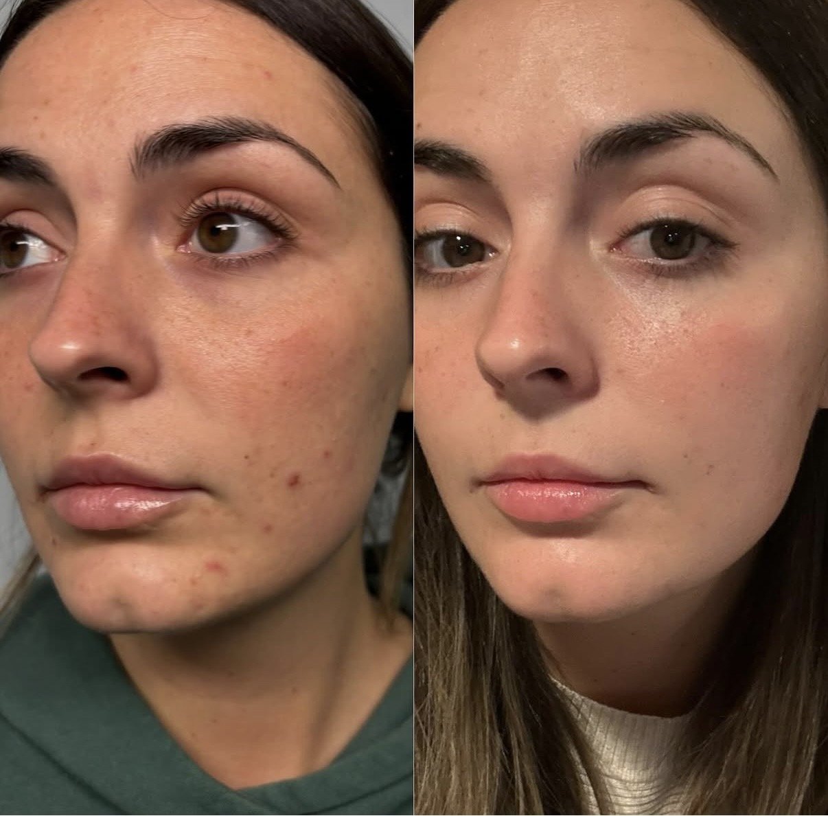Skin quality before and after a Chemical Peel at Novirra in Columbus, Ohio. Located in the Short North. 