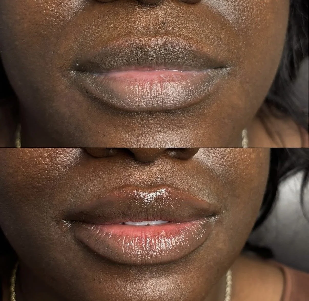 Natural lip filler results at Novirra in Columbus, Ohio. Located in the Short North.