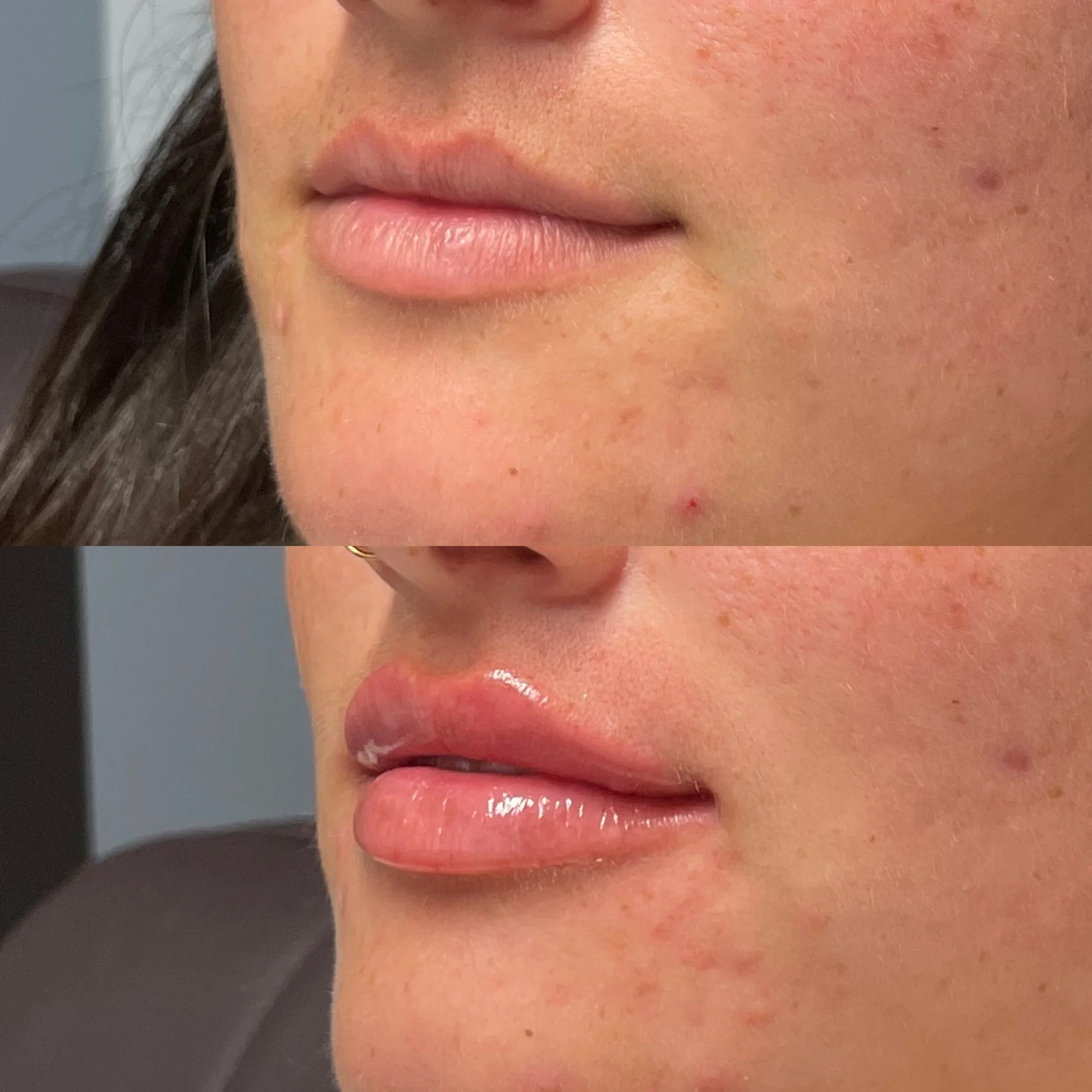 Natural lip filler results at Novirra in Columbus, Ohio. Located in the Short North.
