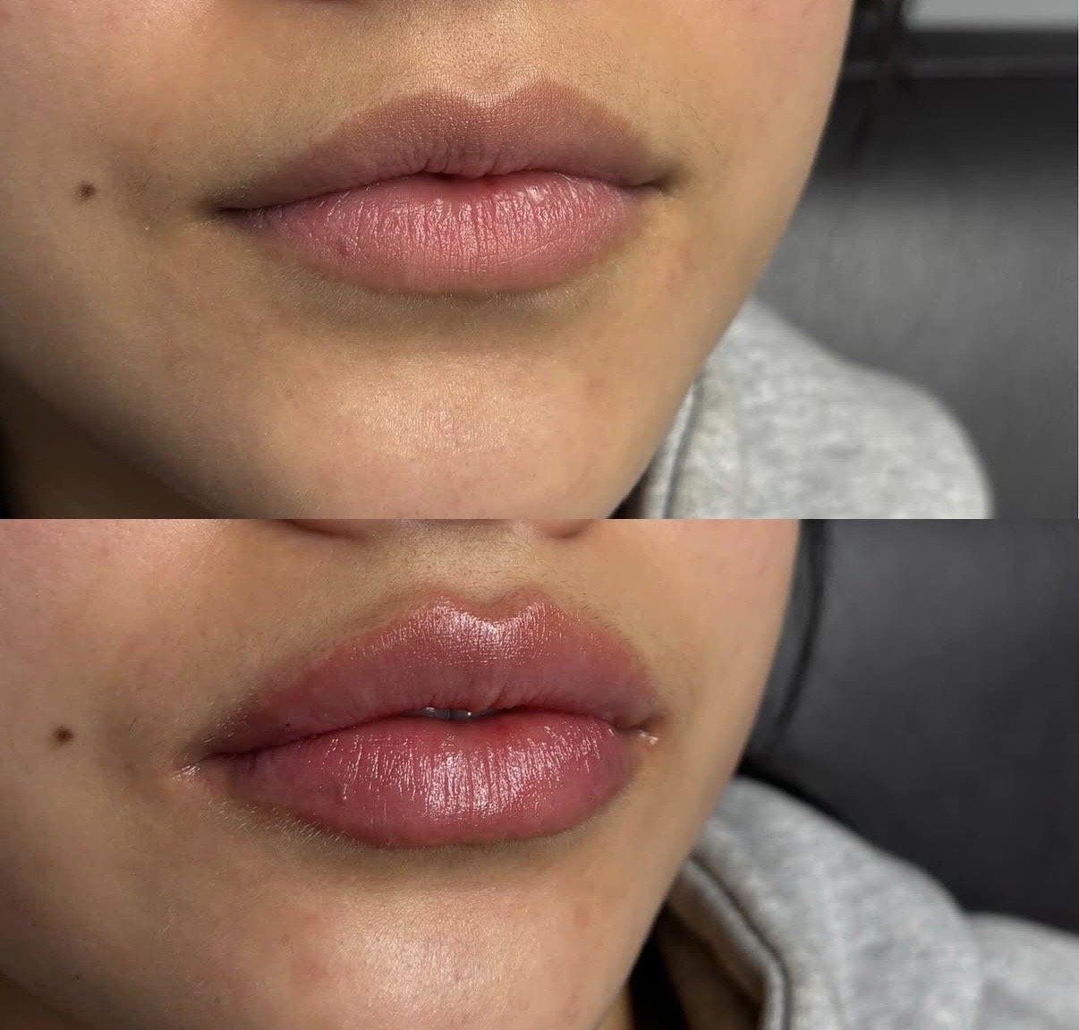 Natural lip filler results at Novirra in Columbus, Ohio. Located in the Short North. 