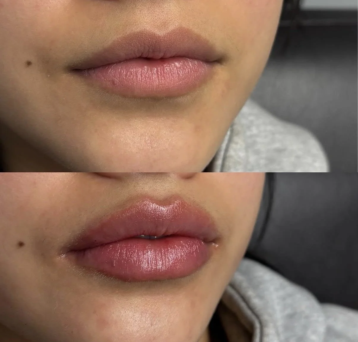Natural lip filler results at Novirra in Columbus, Ohio. Located in the Short North.
