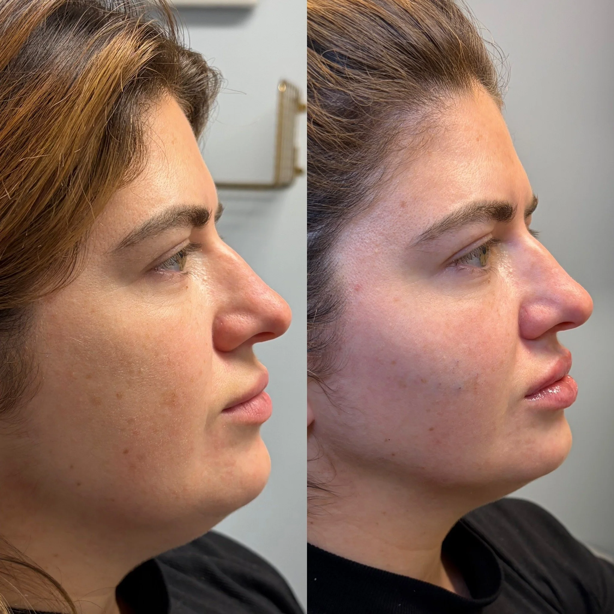 
Facial balancing dermal filler before and after at Novirra in Columbus, Ohio. Located in the Short North.