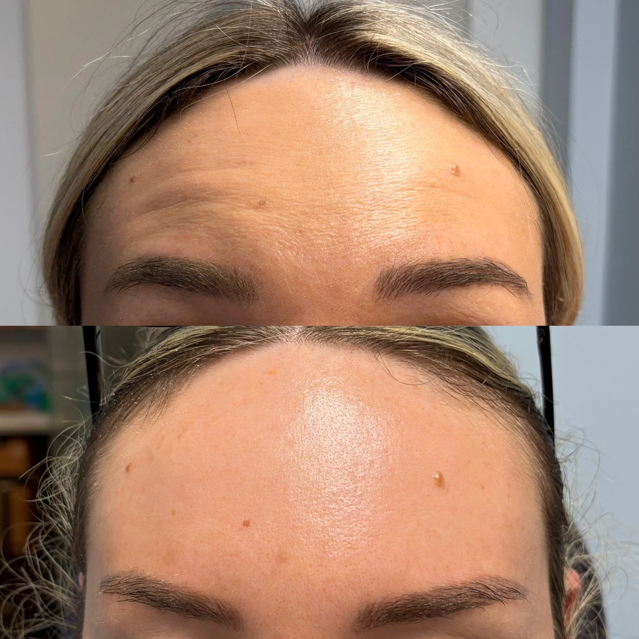 Wrinkle relaxer (Xeomin) before and after at Novirra in Columbus, Ohio. Located in the Short North.