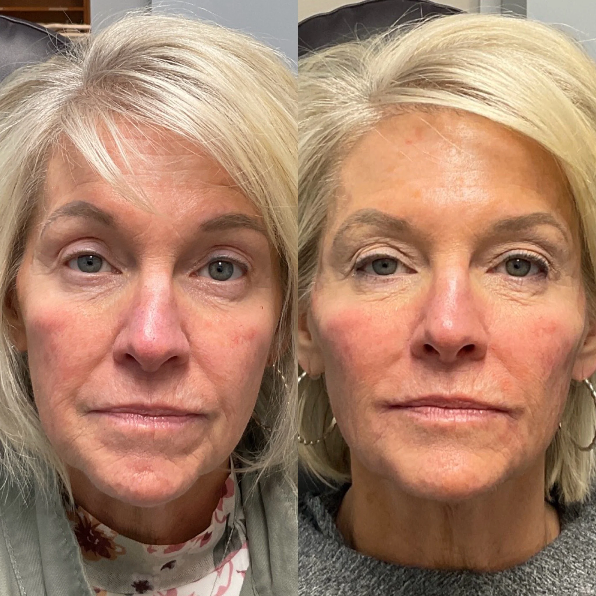 
Facial balancing dermal filler before and after at Novirra in Columbus, Ohio. Located in the Short North.