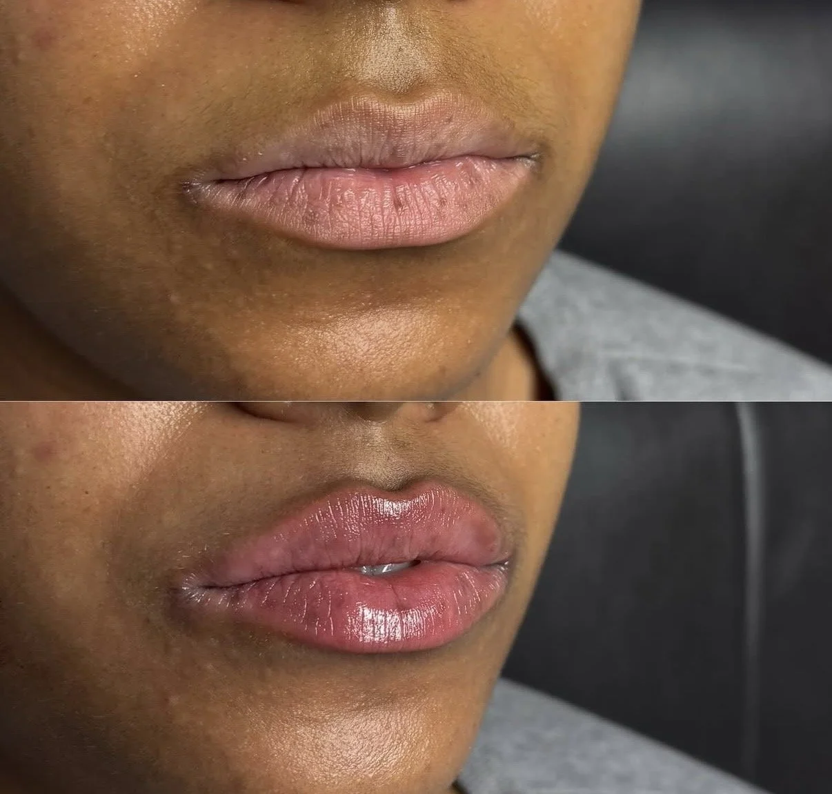 Natural lip filler results at Novirra in Columbus, Ohio. Located in the Short North.
