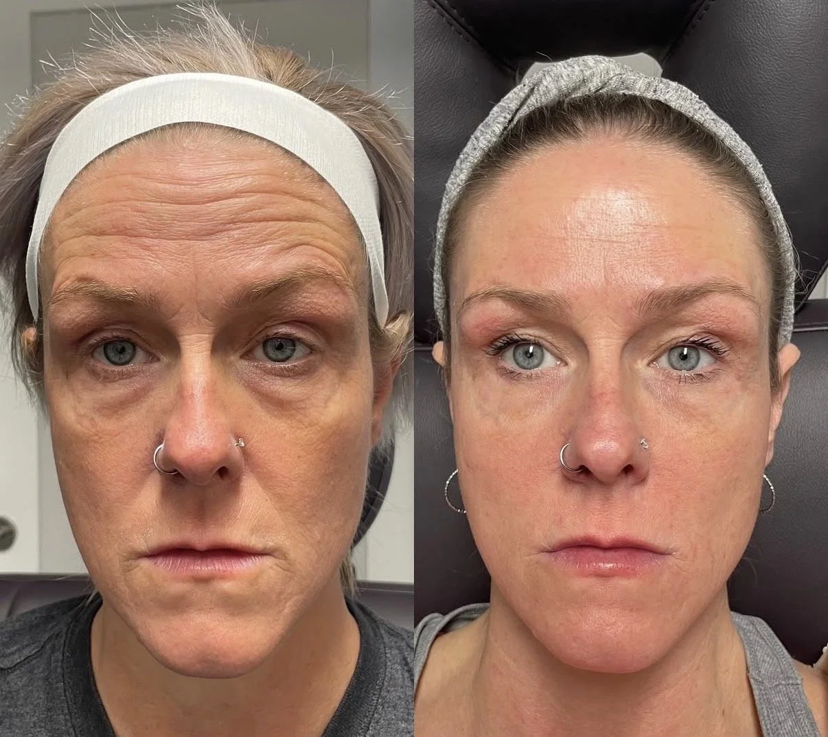 Facial balancing dermal filler before and after at Novirra in Columbus, Ohio. Located in the Short North. 