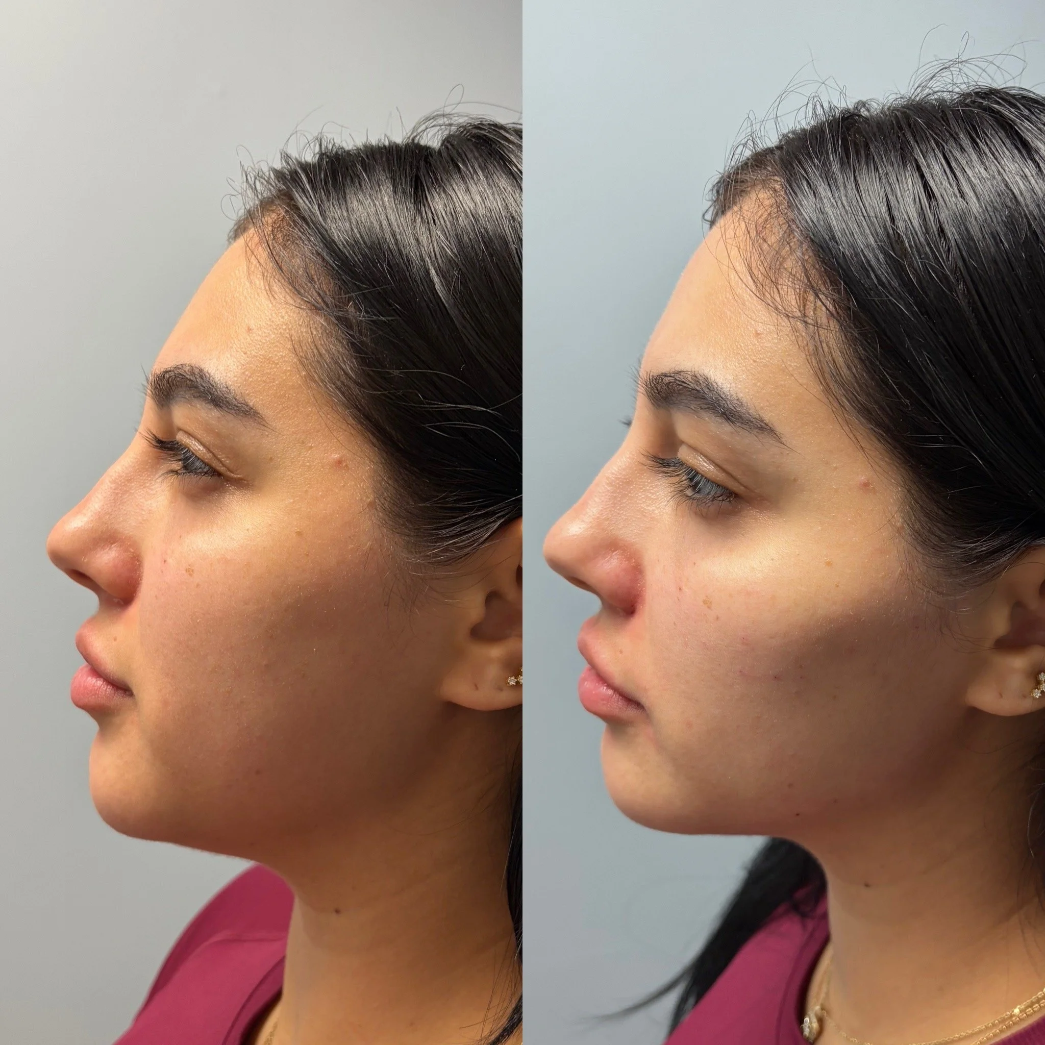 Facial balancing dermal filler before and after at Novirra in Columbus, Ohio. Located in the Short North.