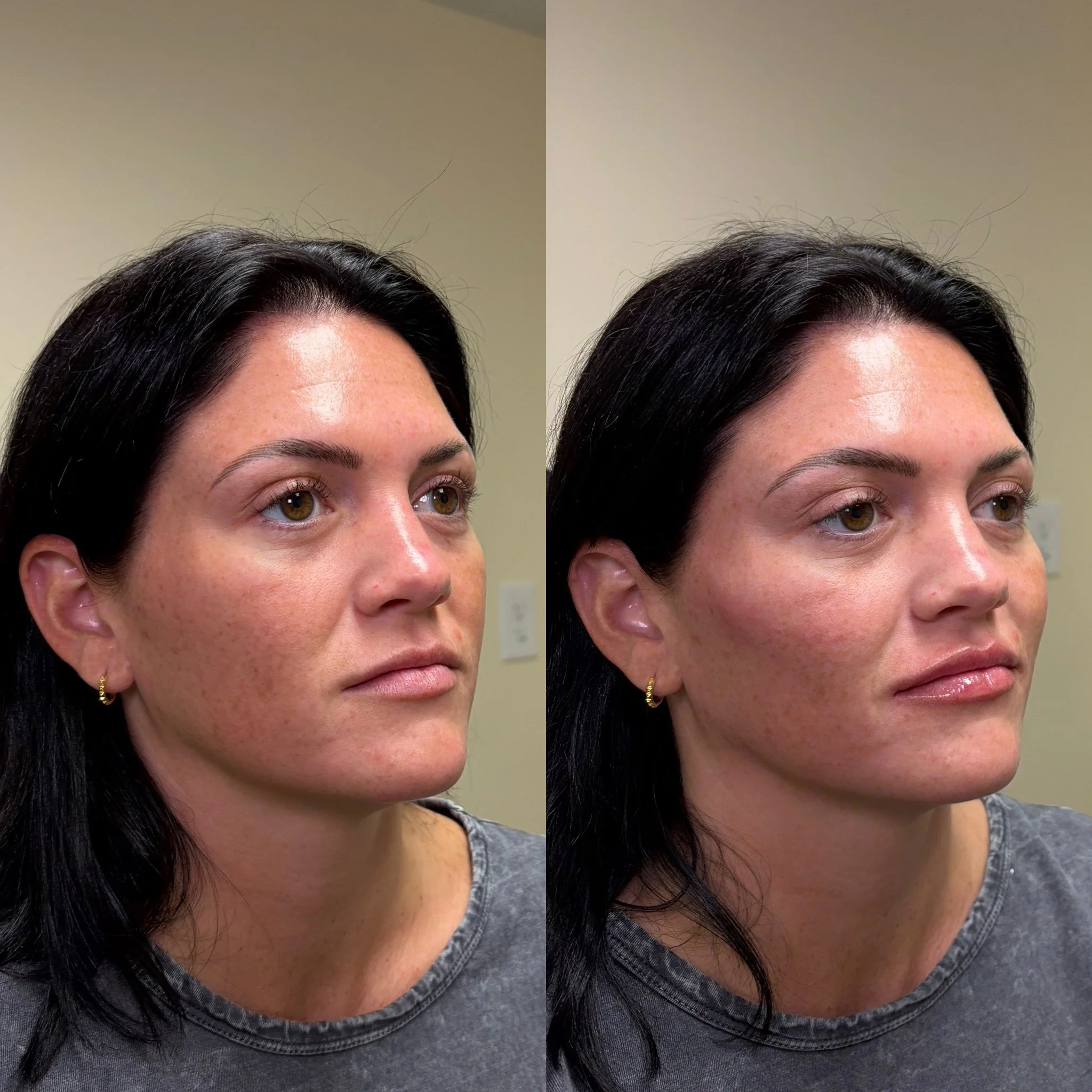 Facial balancing dermal filler before and after at Novirra in Columbus, Ohio. Located in the Short North. 