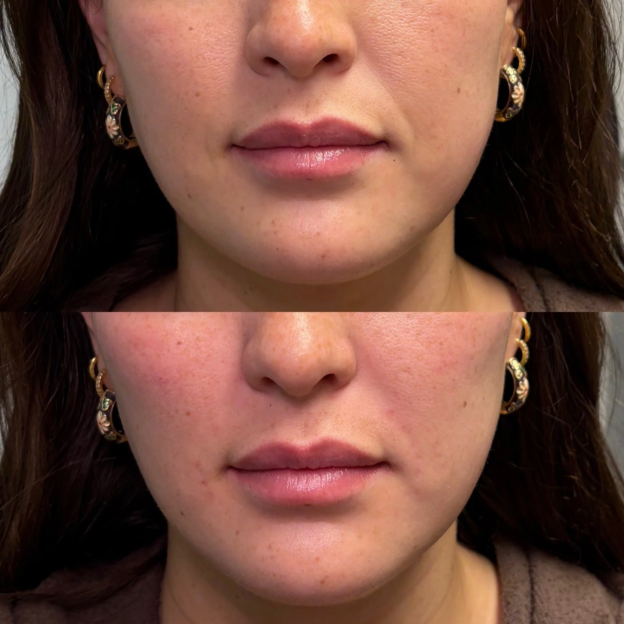 Facial balancing dermal filler before and after at Novirra in Columbus, Ohio. Located in the Short North. 