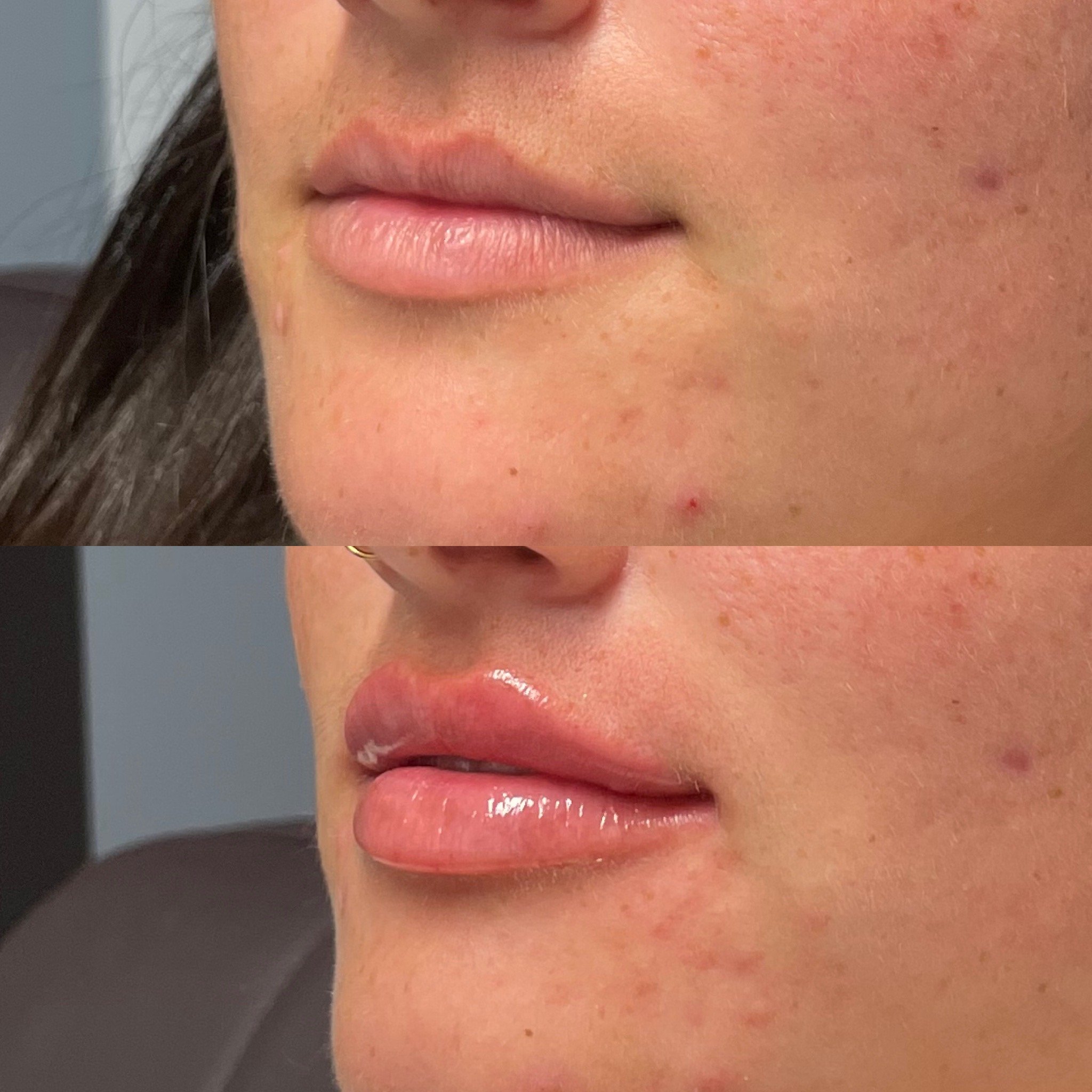 Natural lip filler results at Novirra in Columbus, Ohio. Located in the Short North. 